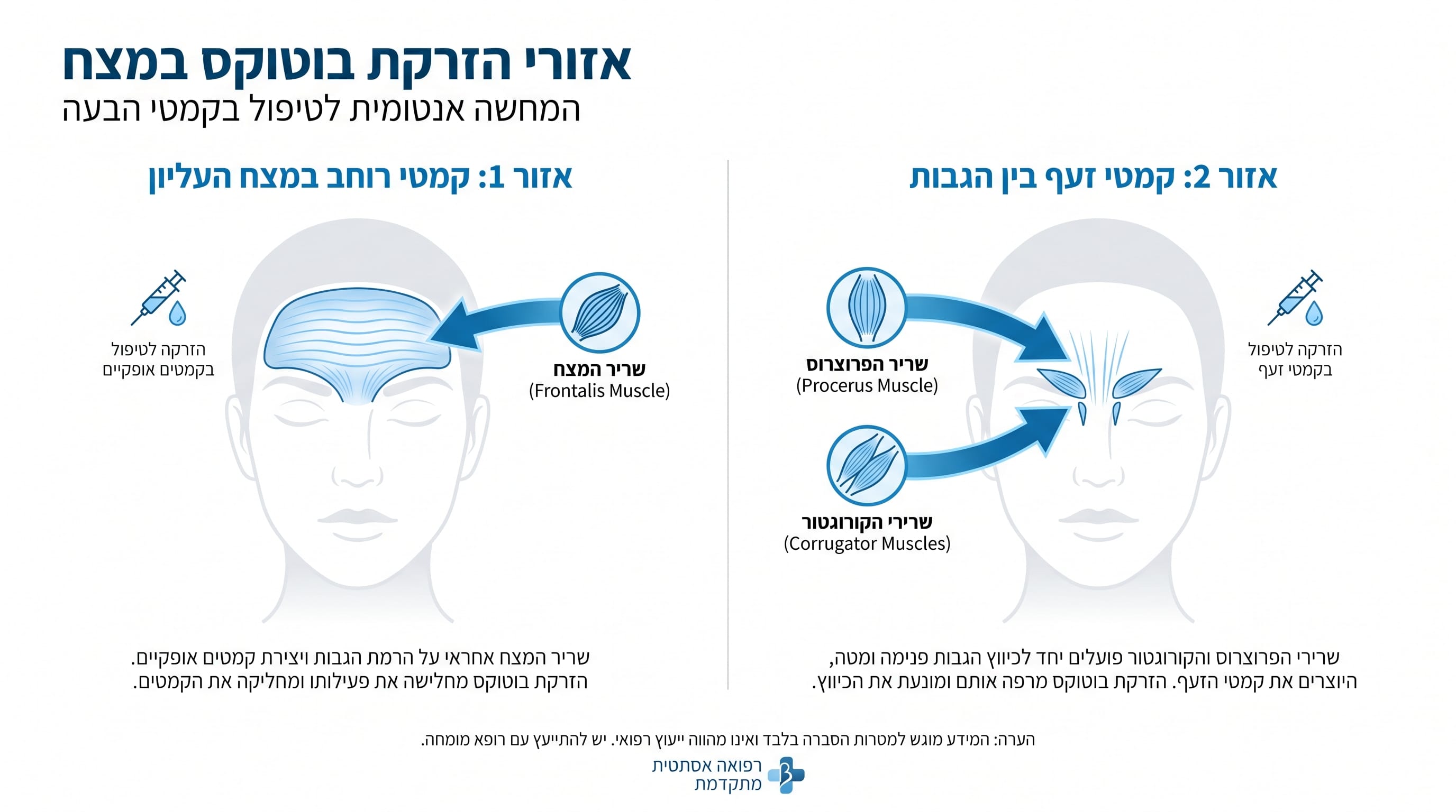 בוטוקס מצח – הפתרון לקמטים: כל מה שצריך לדעת